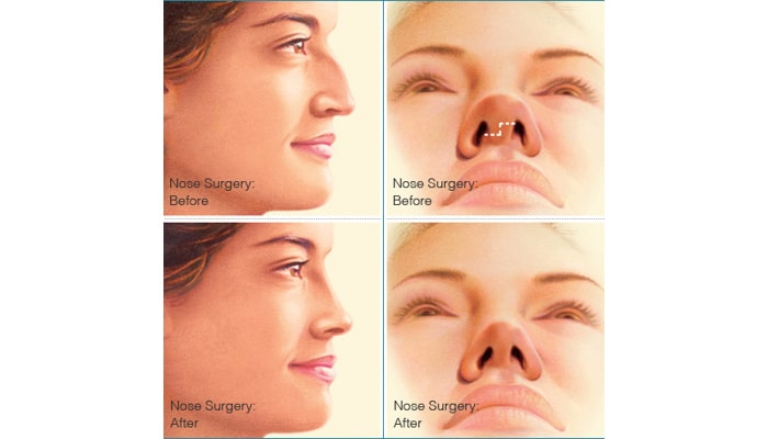 Nose job - before and after